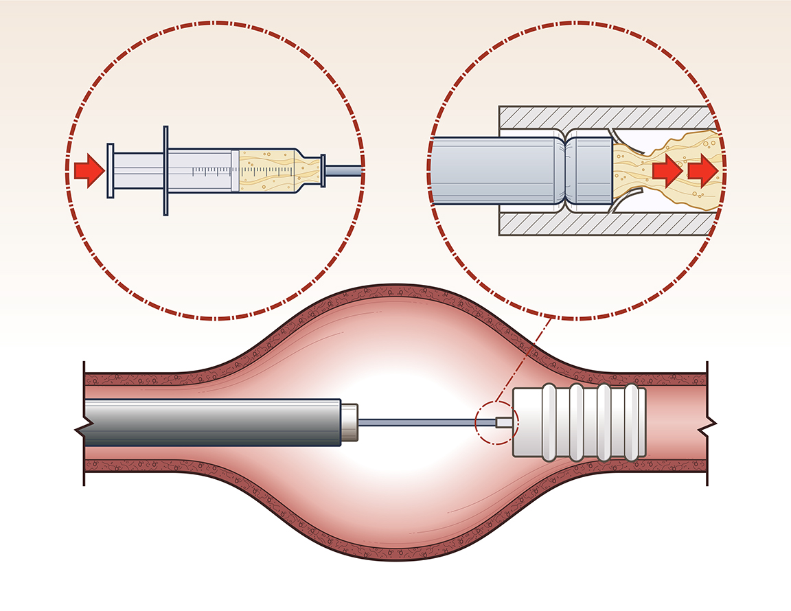 Enlarged Surgery Steps